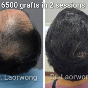 6500株大量植毛☆広範囲ふさふさ