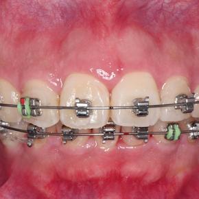 マウスピース矯正といえばインビザラインが有名だけど、単体ではできない症例が多いので、やる前には情報の収集がとても大切です。歯科難民にならないようにしましょう。