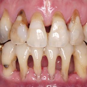 矯正失敗などで重度の歯周病になり、歯根が剥き出しになり抜歯して総入れ歯を薦められた人が、GVBDOで治療を受けると20年経過しても歯を失うことはない、というエビデンスの治療