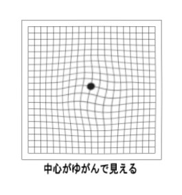 黄斑上膜除去手術から3年。しなくてもよかったかも・・・！？。⑨