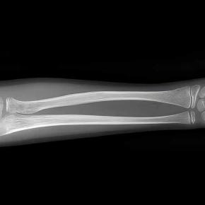 骨粗しょう症一歩手前！骨密度72％から84％に上昇
