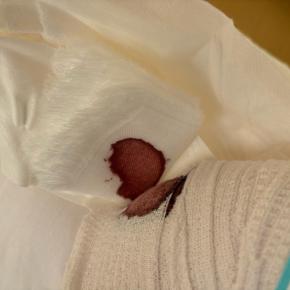 出血だぁぁ((((；ﾟДﾟ)))))))入院3日目