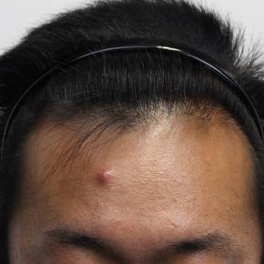 症例写真(331)30代後半男性:毛根再生注射+メソセラピー