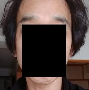 植毛手術3度の前後比較