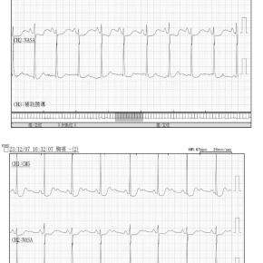 STレベル低下と心拍数の関係性をみると・・・？悩ましくなる