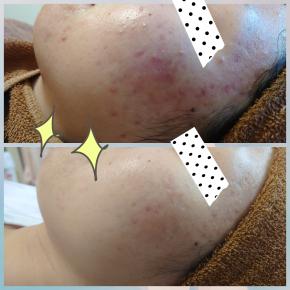 【ニキビ跡の改善方法】改善に必要な3つのステップとは？