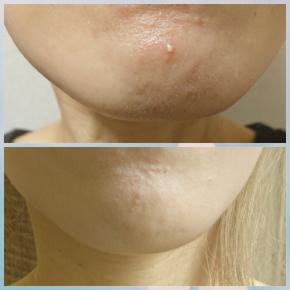 ニキビが1日や2日で治るのは。