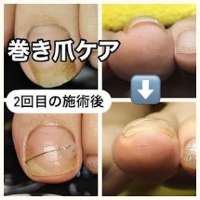 巻き爪矯正（20代のお客様）