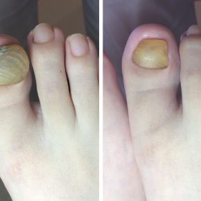 爪の保湿♪厚い爪、巻き爪、肥厚爪、変形爪の方に＾＾