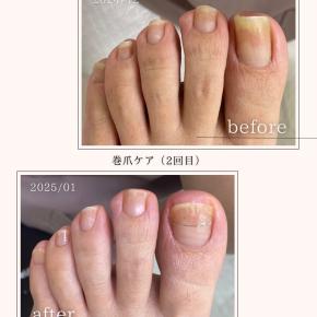 痛い巻き爪🌀