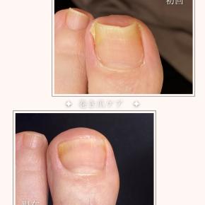 お悩みの巻き爪🌀良くなりました！！🌞