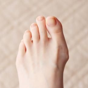 足のアーチ崩れが招く外反母趾と足底筋膜炎のリスク