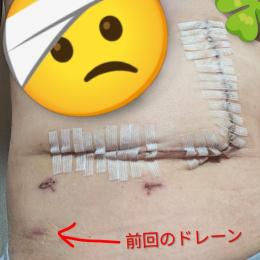 退院後1日目・2日目～日常生活と傷跡画像～