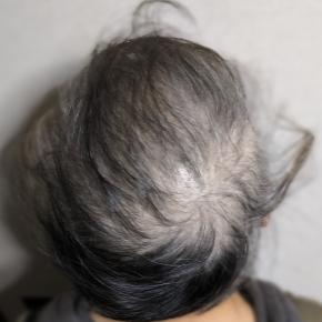 薬物療法(抗がん剤治療)5回目★14日目★通算49日目