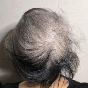 薬物療法(抗がん剤治療)前半6回★6日目★通算62日目