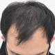 驚異の発毛シリーズ（1134）～20代の進行した薄毛を最新毛髪再生治療で治します！