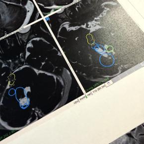 今後の脳腫瘍の見通しについて