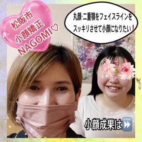 丸顔・二重顎！顔の周りのお肉‼️余分な脂肪を落として一回り小顔に❣️松阪市小顔矯正