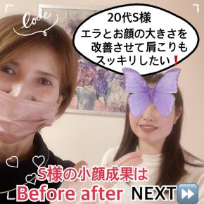一目瞭然❣️エラ張り改善‼️輪郭から美しく✨（20代女性小顔Before after