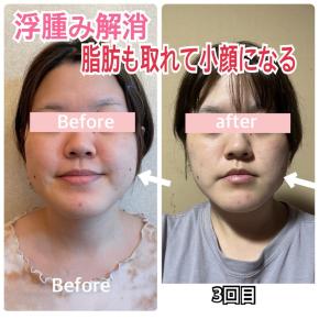 浮腫み解消❗️脂肪も取れてスッキリ小顔に〜（30代小顔Before after）