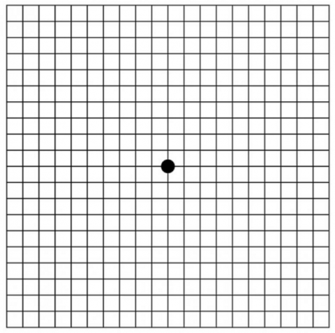 The Amsler grid eye test