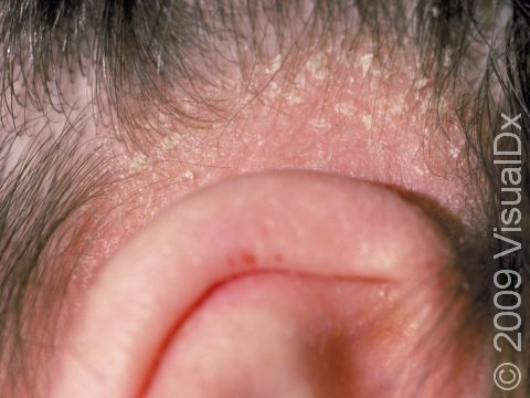 This image displays seborrheic dermatitis on the scalp (dandruff).