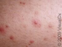 Folliculitis – Adult