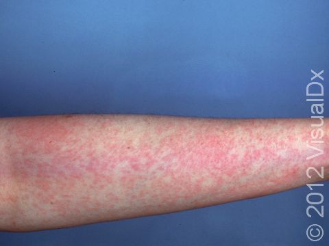 This image displays a fading rubella (German measles) rash.