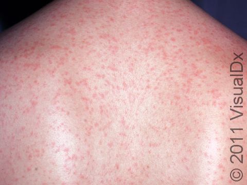 This image displays the pink or red 2-3 mm spots that spread down to the trunk and limbs typical of rubella.