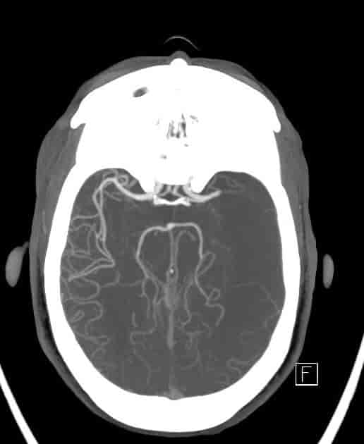 Signs of acute stroke in the left Sylvian territory.