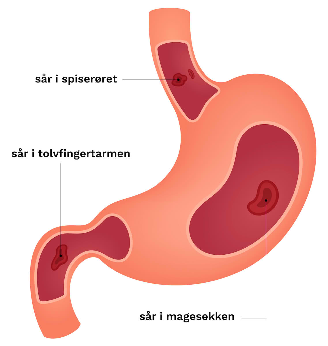 Sår i spiserør, magesekk og tolvfingertarmen