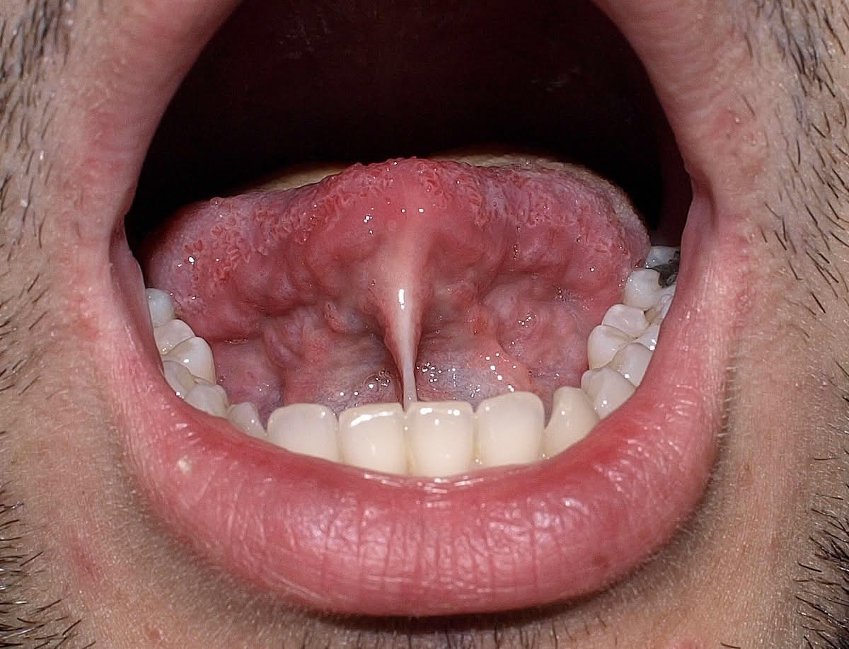 Frenulum linguae