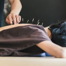 Acupuncture