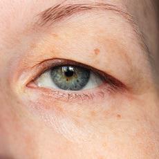 Eyelid Disorders