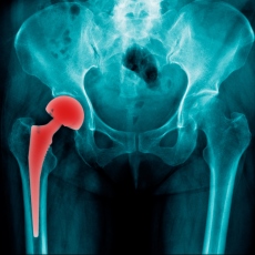 Hip Replacement