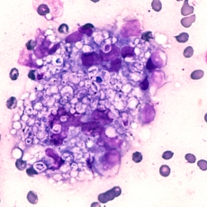 Histoplasmosis