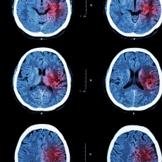 Ischemic Stroke