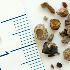 Kidney Stones