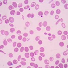 Thalassemia