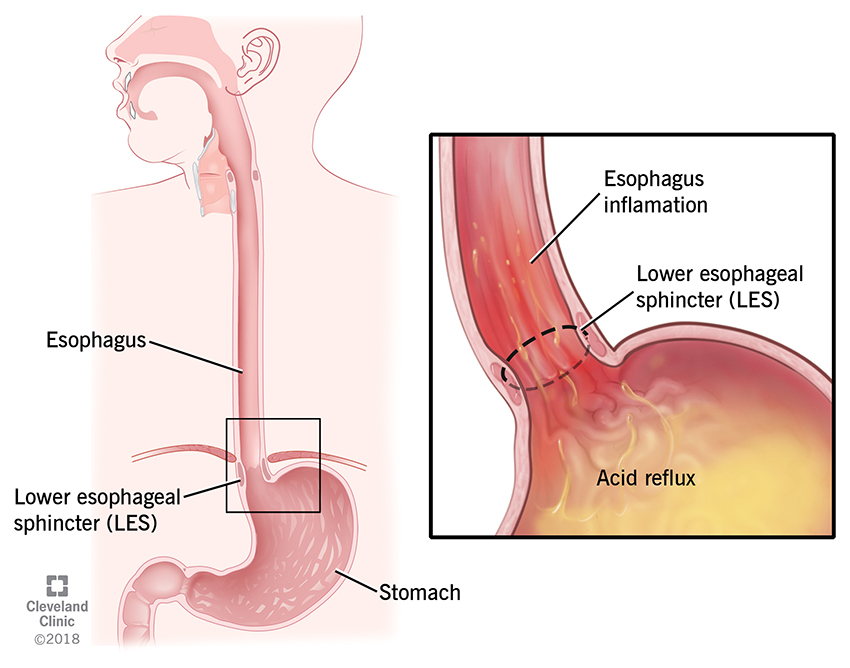 Diagram of the esophagus and stomach showing stomach acid rising into the esophagus.