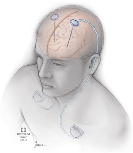 One or more electrodes are positioned in the areas of the brain where abnormal activity  occurs.  The  device that  sends the electrical pulses  to the electrodes are implanted under the collarbone.  Wires placed underneath the skin connect the device to the electrodes.