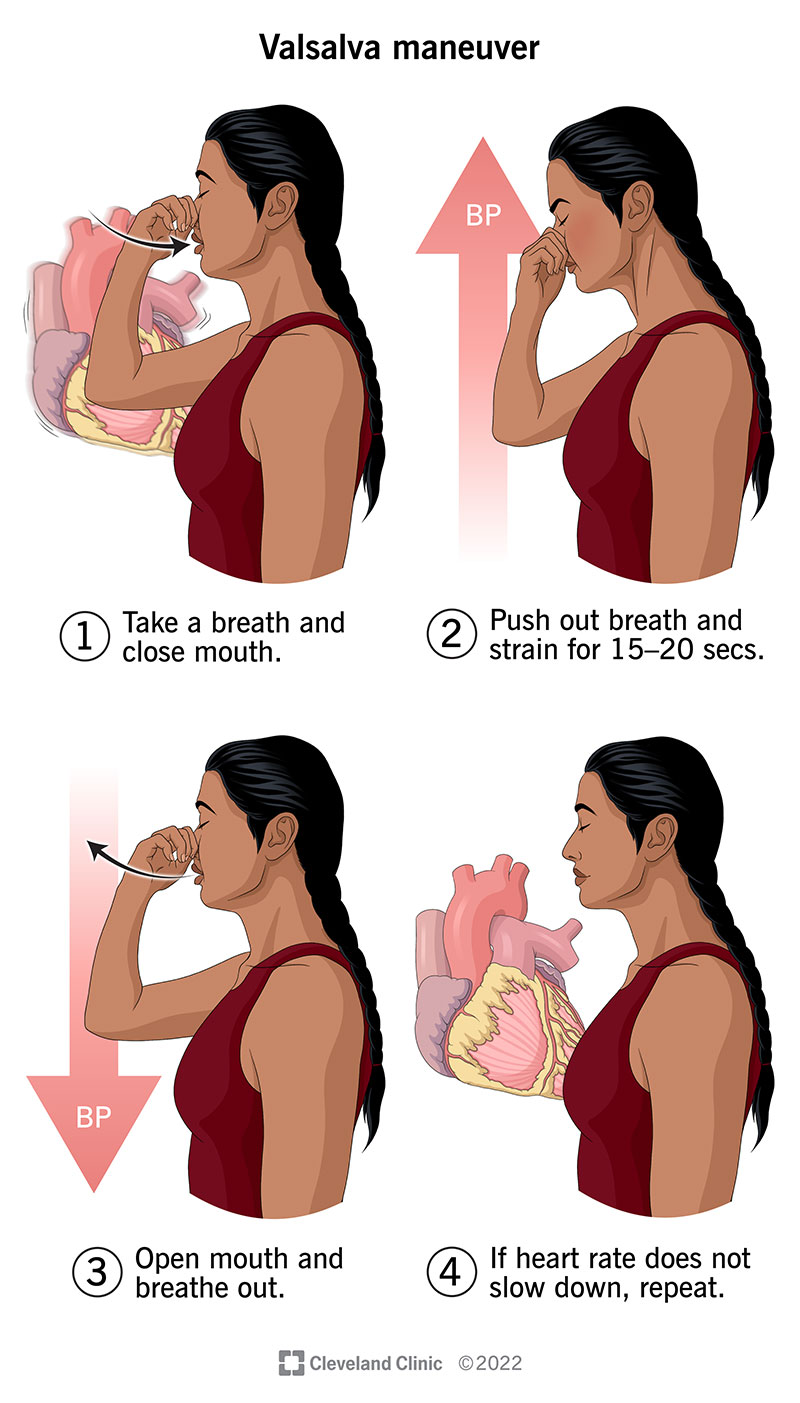 Instructions to perform Valsalva maneuver.