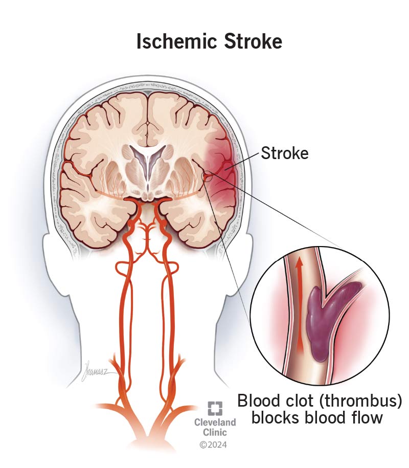 Ischemic stroke blocking a blood vessel in a brain