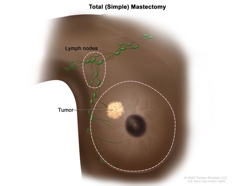 Total (simple) mastectomy; drawing shows removal of the whole breast and some of the lymph nodes under the arm.