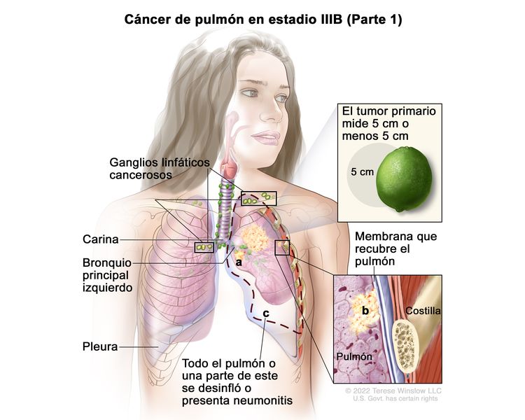 Cáncer de pulmón en estadio IIIB (Parte 1). En la imagen se observan un tumor primario que mide 5 cm o menos en el pulmón izquierdo, y ganglios linfáticos cancerosos encima de la clavícula del mismo lado del tórax que el tumor primario y en el lado contrario al tumor primario. También se observan las siguientes situaciones: a) el cáncer se diseminó al bronquio principal; b) el cáncer se diseminó a la membrana que recubre el pulmón; c) todo el pulmón o una parte de este se desinfló o presenta neumonitis (inflamación del pulmón). Además, se muestran la carina, la pleura y, en un recuadro, una costilla.