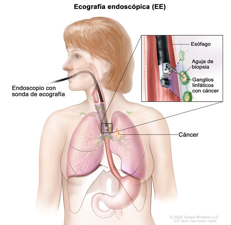 Biopsia por aspiración con aguja fina guiada mediante ecografía endoscópica. En la imagen se muestra un endoscopio con una sonda de ecografía y una aguja de biopsia que se introduce por la boca hasta el esófago. También se observan los ganglios linfáticos cerca del esófago y cáncer en un pulmón. En un recuadro se muestra la identificación de los ganglios linfáticos con cáncer mediante la sonda ecográfica y la extracción de tejido de uno de los ganglios linfáticos cercanos al esófago con la aguja de biopsia.