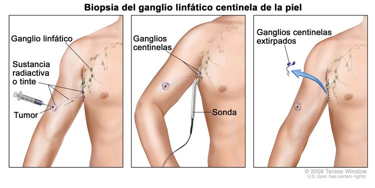 Biopsia de ganglio linfático centinela de la piel. El primero de tres paneles muestra una sustancia radiactiva o un tinte azul que se inyecta cerca del tumor; el panel del medio muestra que la sustancia que se inyecta se puede identificar con la vista o con una sonda que detecta la radiactividad para encontrar los ganglios centinela (los primeros ganglios en absorber la sustancia); el tercer panel muestra la extirpación del tumor y los ganglios centinela para determinar si tienen células cancerosas.