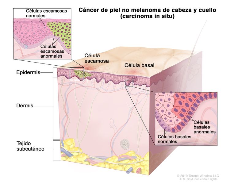 Cáncer de piel no melnoma de cabeza y cuello (carcinoma in situ). En la imagen se observan células escamosas y células basales normales y anormales en la epidermis. También se muestran la dermis y el tejido subcutáneo debajo de la dermis. Hay dos recuadros: en el recuadro de la izquierda se muestra una ampliación de las células escamosas normales y anormales; en el recuadro de la derecha se muestra una ampliación de las células basales normales y anormales.