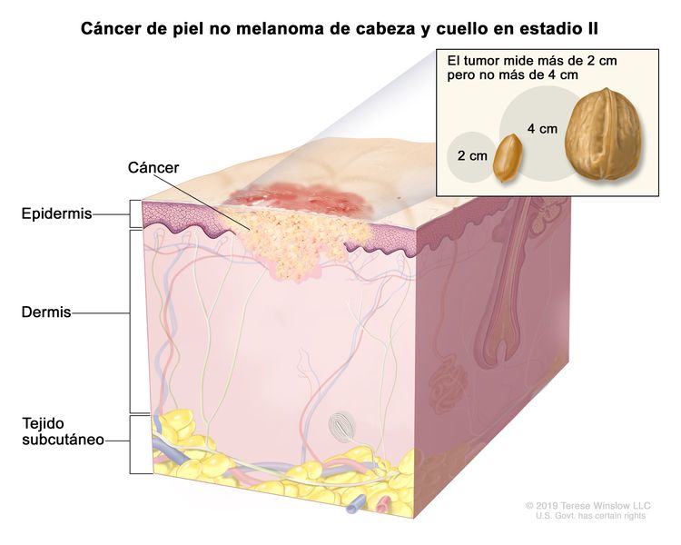 Cáncer de piel no melanoma de cabeza y cuello en estadio II. En la imagen se observa cáncer en la epidermis y la dermis. En un recuadro se muestra que el tumor mide más de 2 cm pero no más de 4 cm, que 2 cm es casi el tamaño de un maní y 4 cm es casi el tamaño de una nuez. También se muestra el tejido subcutáneo debajo de la dermis.