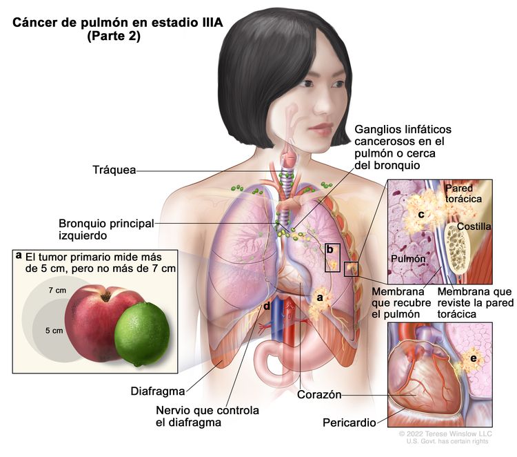 Cáncer de pulmón en estadio IIIA (Parte 2). En la imagen se observa lo siguiente: a) un tumor primario que mide más de 5 cm, pero no más de 7 cm en el pulmón izquierdo y ganglios linfáticos cancerosos en el pulmón o cerca del bronquio del mismo lado del tórax que el tumor primario; b) tumores separados en el mismo lóbulo del pulmón que el tumor primario; c) el cáncer se diseminó a la pared torácica, así como a la membrana que recubre el pulmón y la membrana que reviste la pared torácica (recuadro superior izquierdo); d) el cáncer se diseminó al nervio que controla el diafragma; e) el cáncer se diseminó al pericardio (recuadro inferior izquierdo). También se muestran la tráquea, el bronquio principal izquierdo, el diafragma, el corazón y, en el recuadro superior derecho, una costilla.